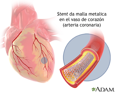 Stent de arteria coronaria Stent de arteria coronaria