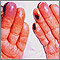 Crioglobulinemia de los dedos Crioglobulinemia de los dedos
