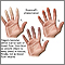 Fenómeno de Raynaud Fenómeno de Raynaud